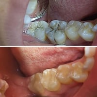 🦷 Class I composite restorations of teeth No.46 & 47  من حالات اليوم  ...