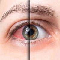 كان جفاف العين في السابق مرتبطاً بتقدم السن، ولكن مع زيادة استخدام الأ...