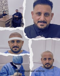 زراعة شعر • نتيجة طبيعية • الشطرة