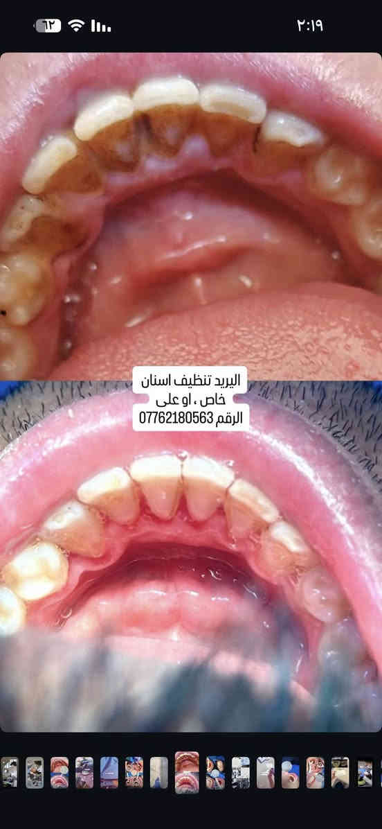 تتوفر لدينا عيادات مجانيه
تنظيف وتلميع الاسنان وازالة التكلسات والتصبغات
قلع جذور الاسنان التالفه التي تسبب رائحة كريهه والتهابات
وقلع الاسنان المتحركة سواء لبنية او دائميه
الحجز خاص
او على الرقم ***********
