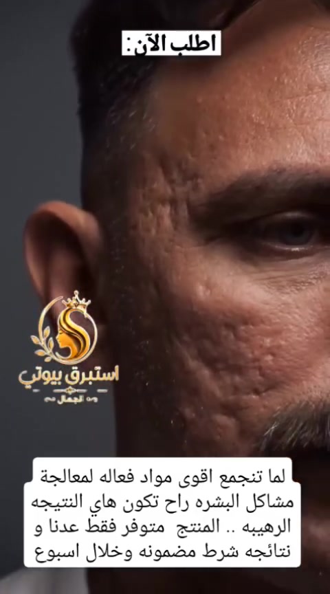مو كل كريم يعطي نتيجة... لكن الاختيار الصح يصنع الفرق!
إذا تعبتي من الحفر، المسام، آثار الحبوب أو بهتان البشرة، فهذا المنتج صُمم حتى يمنح بشرتك عناية حقيقية ونتيجة تلاحظينها مع الاستمرار.
✔️ بشرة أنعم
✔️ إشراقة أوضح
✔️ ثقة أكبر بنفسك
📦 الكمية محدودة، لا تنتظرين حتى يخلص العرض.
راسلينا الآن واحجزي طلبج قبل نفاد الكمية


**إذا كنت صاحب هذا الإعلان وتريد حذفه لأي سبب، رجاءا أرسل رسالة إلى الدعم الفني**