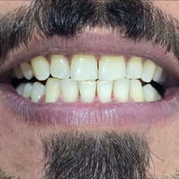 تنظيف أسنان • تلميع أسنان • الحبانية