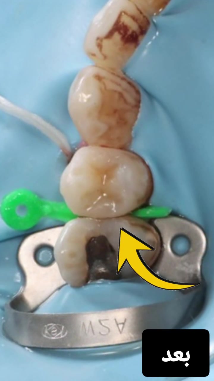 💯حشوات تجميلية سيراميك بيضاء بيد دكتورة فرح اختصاص تجميل الاسنان+خبرة ١٤ سنه  🤩
بعقوبة☘️ مدخل شفته الرئيسي
***********☎️ للحجز
