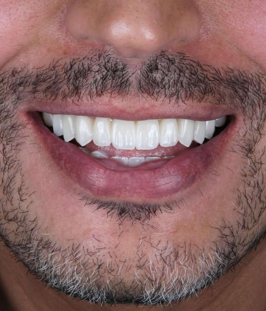 “لا تكتمل آناقتك إلا بآسنان بيضاء ولامعة

متواجدين لخدمتكم طيلة أيام الأسبوع
#مراكز_الشركة_الطبية_العالمية
العنوان البصره قضاء الفاو - سوق الفاو الجديد - مجمع الجهاد الطبي الطابق الثاني - فوق عياده د عادل عطيه .
الرقم / ***********
