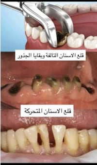 قلع أسنان • علاج مجاني • البصرة