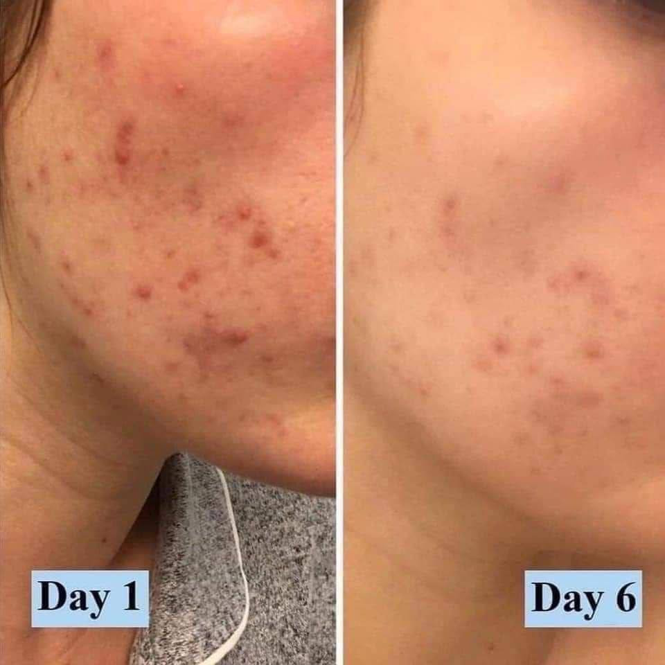 ‏PanoXyl acne foaming wash🦋💧الامريكي🇺🇸 الاصلي💯 

غسول بانوكسيل رغوي متعدد الاستخدامات وازالة حب الشباب وارثاره من الوجه والصدر والضهر وتصفية البشرة والجسم من بانوكسيل من مادة البنزويل بيروكسايد 10%

غسول بانوكسل الوجه الرغوي ماكسيموم سترينث لحب الشباب للوجه والجسم والمناطق الحساسه 
من بانوكسيل يحتوي على 10% بنزويل بيروكسيد
✅ غسول رغوي فائق القوة. 
يخترق المسام بفعالية ويقتل البكتيريا التي تسبب حب الشباب
✅ يزيل عيوب حب الشباب الموجودة ويمنع ظهور عيوب جديدة
✅ أعلى قوة من بيروكسيد البنزويل المتاحة بدون وصفة طبية
✅ يزيل الأوساخ والزيوت الزائدة بلطف لتنظيف المسام وفكها. مما يجعله خيارًا ممتازًا للتحكم في حب الشباب على الوجه والصدر والظهر.
✅ يحتوي علي بينزويل بيروكسايد 10‎%‎ يعمل علي ازالة حب الشباب ويساعد علي عدم ظهورها 
✅ خال من العطور والبارابين وميزته يحتوي علي مرطب يعني 
ميسبب جفاف للبشرة

للسعر:: 12الف

توصيل لجميع المحافظات 🇮🇶:: 4.


**إذا كنت صاحب هذا الإعلان وتريد حذفه لأي سبب، رجاءا أرسل رسالة إلى الدعم الفني**