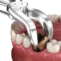 مجاناً...يتوفر قلع الاسنان و الجذور التالفه🦷 في عيادات طب الاسنا مجانا...