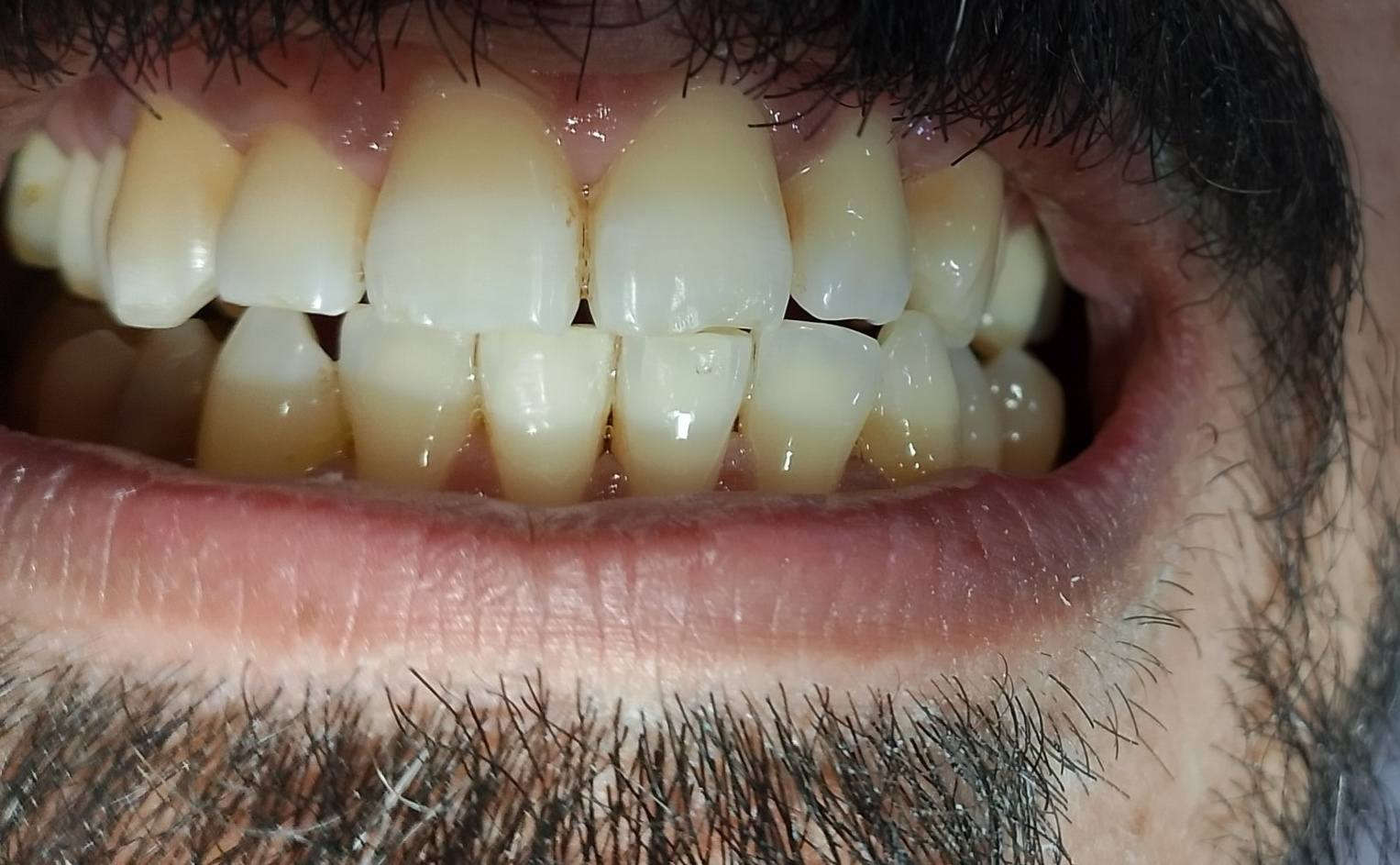 🦷 قبل وبعد تنظيف الأسنان وإزالة التكلسات 

إحدى الحالات التي تم العمل عليها داخل العيادات التعليمية

الفرق واضح في الوظيفة والمظهر 👌

🔹 الخدمات المتوفرة حاليًا (مجاني ):
• حشوات تجميلية ضوئية
• قلع الأسنان
• عمل طقم متحرك
• تنظيف الأسنان وإزالة التكلسات

📍 العمل يتم داخل العيادات وتحت إشراف مختصين

📱 للحجز والتواصل واتساب: (0770 984 7469)

#طبيب #اسنان # اكسبلور #فولو #لايك #تعليق
