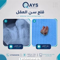 � حالة اليوم | قلع ضرس العقل  حضر المريض وهو يعاني من ألم ناتج عن ضرس ...