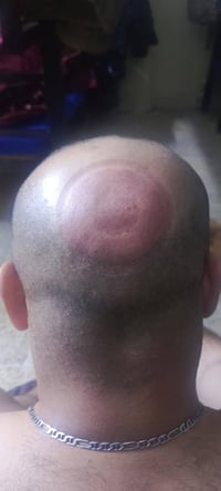 حجامة • سحب العمود الفقري • القصيرين