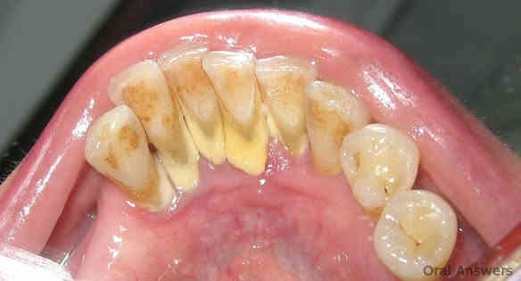 سلام عليكم
متوفر عدنا هاي الحالات للعلاج: 
_حشوات 
_قلع الاسنان وبقايا جذور 
_تنظيف تكلسات وازالة تصبغات 
_ تعويض الاسنان بطقم كامل 
_ حالات مرضيه بالفم 
علماً ان: 
_العلاج مجاني 100٪. 
_ ويكون العلاج بأشراف اطباء مختصين بالحالات المذكوره اعلى. 
للتواصل ولاستفسار متواجدين  
خاص على ماسنجر. 
وكذالك على رقم الواتساب ***********
