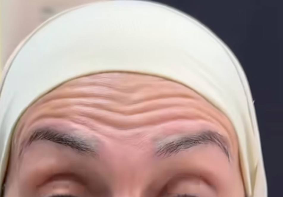 شوفوا نتاىج البوتوكس بعد اسبوع من الحقن حتة من ترفع حواجبه بعد ماكو اي تجاعيد ،،،وعافيات عليكم التخفيضات متابعيني صعدوا منشور التخفيضات الي نزلتة قبل يومين سووا تاكات ومشاركات ودخلوا للمسابقة


**إذا كنت صاحب هذا الإعلان وتريد حذفه لأي سبب، رجاءا أرسل رسالة إلى الدعم الفني**