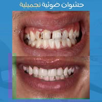 حشوات تجميلية • أسنان أمامية • السماوة الإسكان