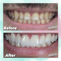 علاج أسنان مجاني • تقييم مجاني • عدد محدود