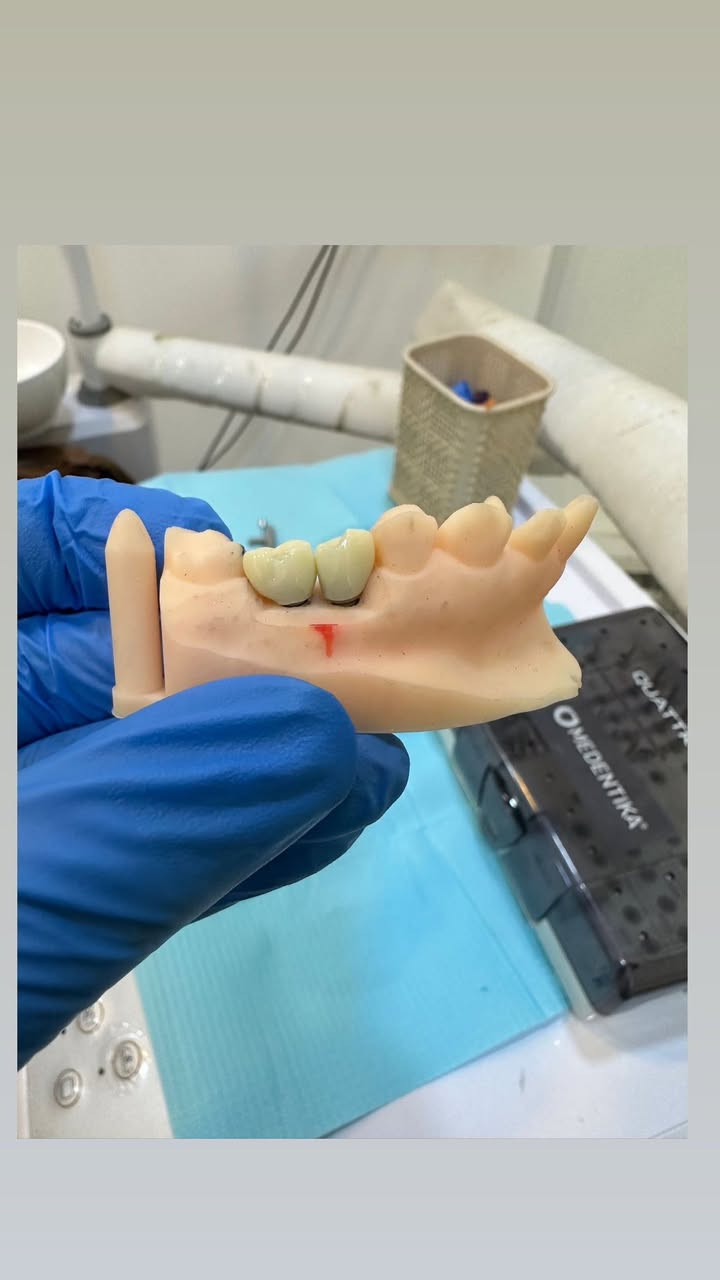 تثبيت زرعات الأسنان بعد ثلاث أشهر من أكتمال عملية 
شفاء العظم واللثة وأكتمال ثباتية الزرعة داخل العظم 
للتواصل والأستفسار عن الزراعة 
الرقم *********** 
د. حسين كاظم العگيلي 
عيادة الآيات لطب الأسنان 
النجف الاشرف - حي الزهراء - شارع المدارس
