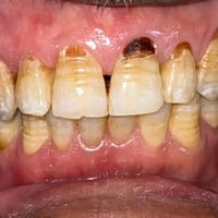 حشوات امامية مجانا للاسنان مكسورة او متسوسة  مكان شارع فلسطين جامعة ال...