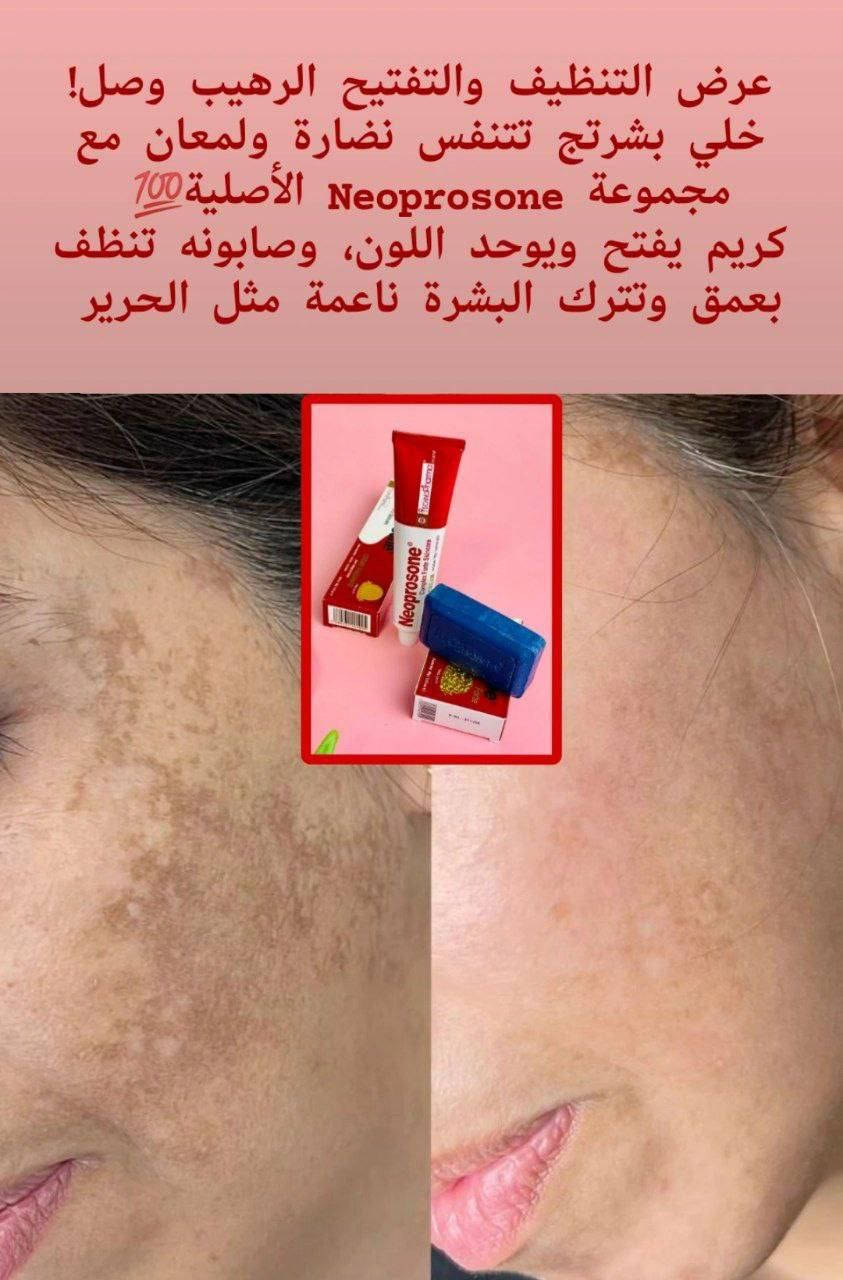 الكلف مزعجج؟ النمش مضايقج؟ خلي Neoprosone يرجّعلج صفاء بشرتج يقلل التصبغات، يفتح اللون، ويخلي الوجه صافي مثل الحليب يتكون من عصاره +صابونة 💯💯
♦️. كريم نيوبروسون المشهور عالميا 
Neoprosone Forte 
منتج امن و مجرب ومضمون وماركة عالمية
مكوناته اعشاب امنة على البشرة وعلاجية دائمية قبل متكون تجميلية 
علاج طبي بامتياز
🌟 اهم المميزات 🌟
✔احسن علاج لتفتيح وتبيض البشرة
✔معالجة للكلف والنمش 
✔معالجة للاكزمة والطفح الجلدي والحكة والتحسس 
✔معالجة للتصبغات الجلدية والبقع والاسمرار
✔معالجة اثار حب الشباب واسمرار الشمس 
✔خالي من الكورتزون 
✔خالي من الزئبق 
 💡افضل منتج للكلف ولإسمرار البشرة وتقشر الجلد الخارجي وتبيض البشرة وتفتيح لونها👍

♦️. صابونة نبريسون :: Neoprosone
مبيضة لبشره بصورة سحريه 
تخلصك من حب الشباب نهائياً 
علاج للنمش 
علاج للكلف 
علاج للهالات السوداء 
 اعشاب طبيعيه ونباتات طبية 💯

سعر العرض ب 20 والتوصيل مجاني 
مع ضمان اسبوعين اذا متحصلون نتيجه رجعوهن


**إذا كنت صاحب هذا الإعلان وتريد حذفه لأي سبب، رجاءا أرسل رسالة إلى الدعم الفني**