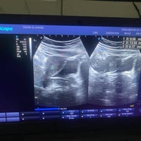 جهاز سونار نوع سونو سكيب نوع E1  بروبين باطني وداخلي نسائي موديل 2020 ...