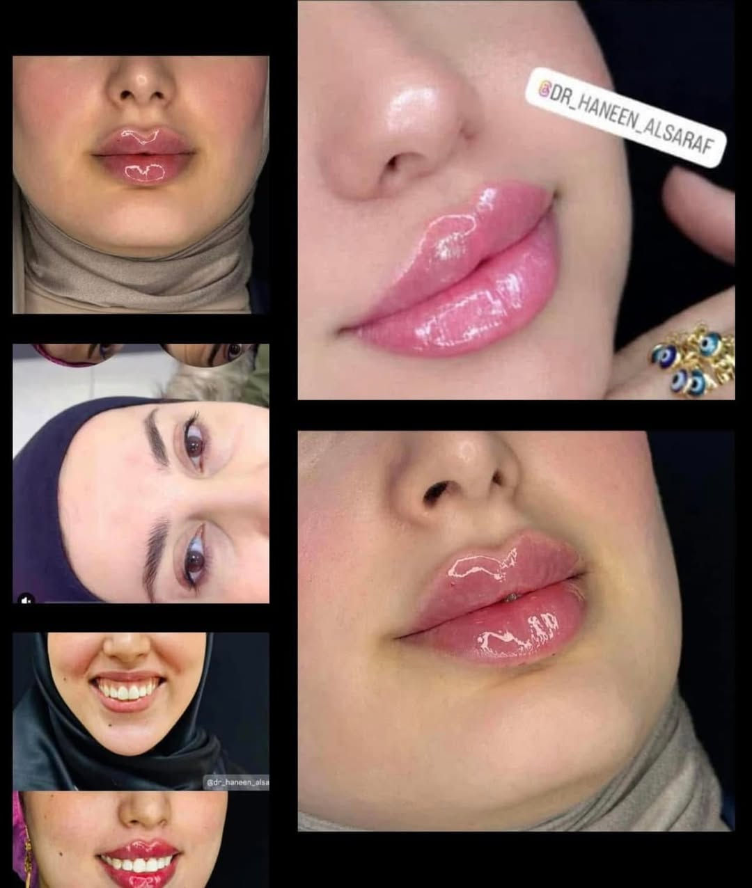 (((.    تتواجد اليوم  )))
✨ الدكتورة حنين الصراف ✨ عودة ميمونة من  السفر وصلت الكوت. 

طب التجميل غير الجراحي | نحت الملامح | شد البشرة

🔥 مو كل تجميل… يصنع فرق.
الفرق الحقيقي هو لما يطلع وجهج أجمل… والكل يلاحظ التغيير بدون ما يعرف شنو السبب.

إذا تبحثين عن:
💎 فيلر طبيعي يبرز جمال ملامحج.
💎 بوتوكس يمنحج مظهراً أكثر راحة ونضارة.
💎 تحديد الفك والذقن والخطوط الجانبية.
💎 شد الوجه والرقبة بطرق غير جراحية.
💎 علاج الابتسامة اللثوية (Gummy Smile).
💎 تجديد البشرة واستعادة إشراقتها.

فأنتِ مع المكان المناسب.

مع الدكتورة حنين الصراف نؤمن أن التجميل الحقيقي لا يغيّر ملامحك… بل يُظهر أجمل نسخة منكِ.

✔️ تقييم دقيق لكل حالة قبل أي إجراء.
✔️ استخدام مواد أصلية من مناشئ عالمية معروفة.
✔️ اختيار التقنية المناسبة حسب طبيعة الوجه واحتياجات كل مراجعة.
✔️ اهتمام بأدق التفاصيل للوصول إلى نتائج متوازنة وطبيعية.

🌸 لأن الثقة تبدأ من أول نظرة في المرآة…

📅 المواعيد محدودة، والحجز حسب أسبقية التواصل.

📲 للحجز والاستفسار:

📸 Instagram:
https://www.instagram.com/dr_haneen_alsaraf/

📘 Facebook:
https://www.facebook.com/Haneenclinic1

📍 الكوت – شارع الهورة – مجمع الطبيب الجراح – الطابق الثاني

☎️ ***********
☎️ ***********
☎️ ***********

الدكتورة حنين الصراف
خبرة… دقة… ونتائج طبيعية تعزز ثقتك بنفسك.
