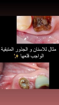 علما ان المعالجة مجانية ولفترة محدودة للحجز 07812152658