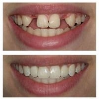 تلبيس أسنان • طقم جزئي متحرك • قرب صيدلية سلامتك