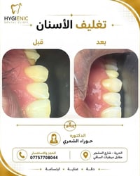 في هذه الحالة تم إجراء تغليف للأسنان ، مما يساعد على تحسين ثباتها والم...