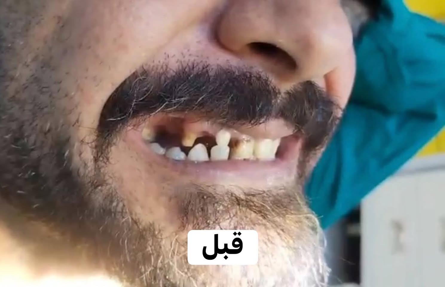تركيب اسنان 🦷 - عيادة د. موسى محمود الكعبي 
📍مركز سومر - الطابق الثاني - شارع الاطباء 
📞***********
