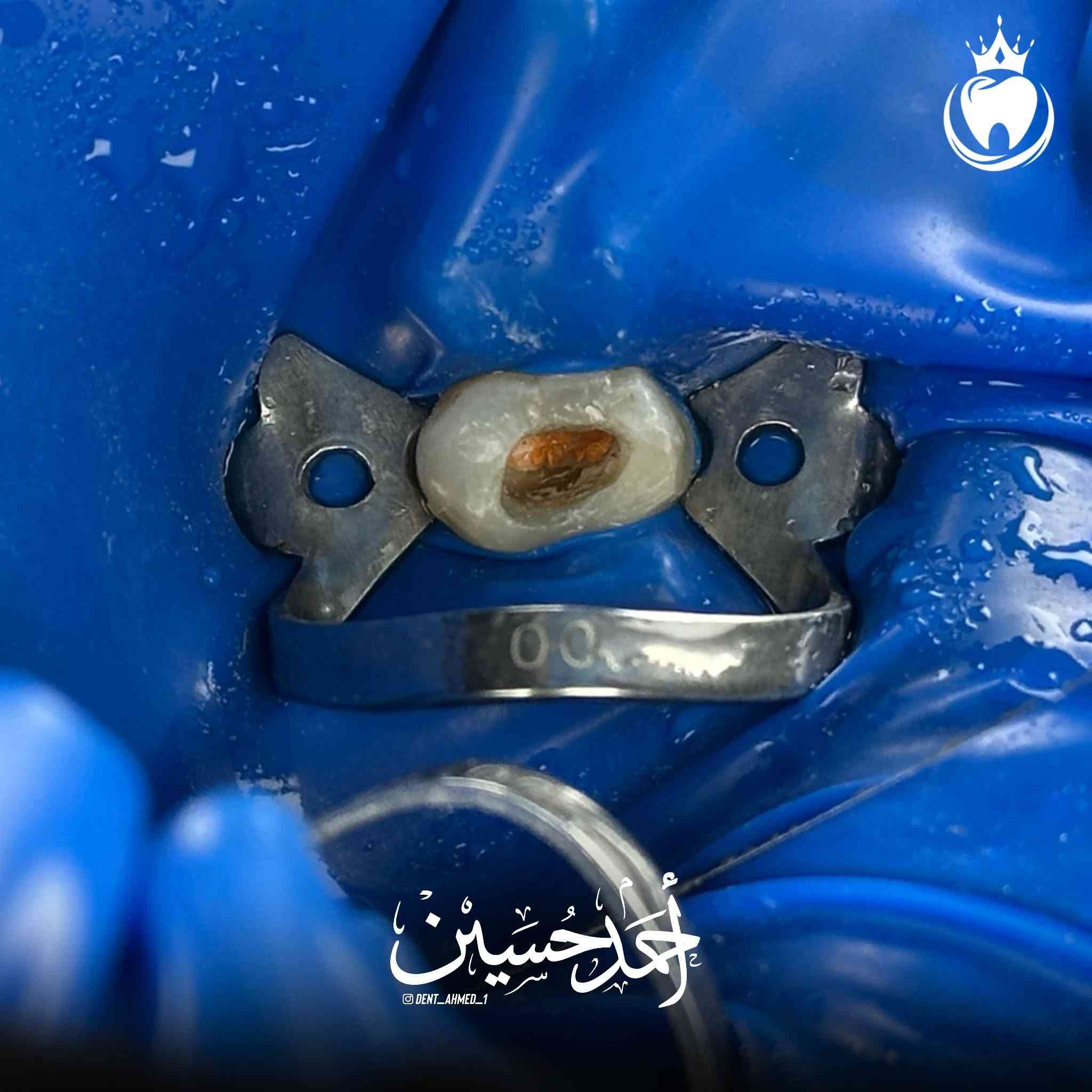 و كالعادة مراجعنا يشكو من الم مستمر في السن الضاحك العلوي و العلاج حشوة جذر مع حشوة تجميلية و اختفاء الالم و لله الحمد

الدكتور أحمد حسين الطعماوي 
المجمع الطبي الحديث مجاور مرطبات كرزة
التواجد جميع ايام الاسبوع بعد صلاة العصر الى الساعة ٨:٠٠ مساءََ
للحجز و الاستفسار :***********
