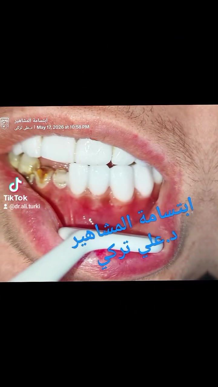 السلام عليكم ❤️
ابتسامه المشاهير 💥
جاري إتمام الابتسامة والعمل عليها ❄️💯
في عيادة لارين لطب وتجميل الاسنان / د.علي تركي  🦷
الحجز والاستفسار ☎️
0774 988 9272
