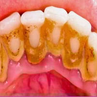 علاج اسنان مجاني • عيادات جامعة الكوفة • تقويم اسنان