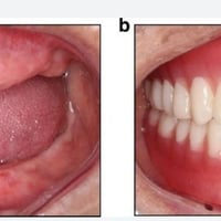خدمات مجانية • علاج تسوس • طقم أسنان