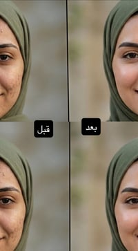 تصبغات الشمس • كلف الحمل • آثار الحبوب