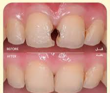 مجانا مجانا مجانا 
تعلن عيادات الصفوة الجامعه عن توفير خدمات مجانية 
_قلع الأسنان التالفه والجذور المتبقيه 
_تنظيف الأسنان وإزاله التكلسات 
_تعويض الأسنان بطقم متحرك 
_حشوات تجميلية 
المواعيد الأحد والثلاثاء 
للحجز مراسله الصفحة أو المراسلة ع الواتساب فقط ***********
كربلاء -حي النقيب - مقابل مطعم ناز
