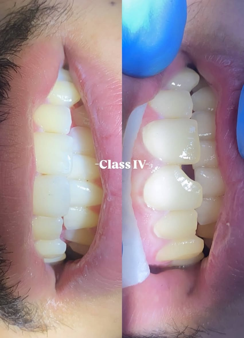 علاج اسنان مجاني في عيادات جامعة المنارة
للحجز الاتصال على الرقم 
 ‏‪0770 702 4073‬‏
