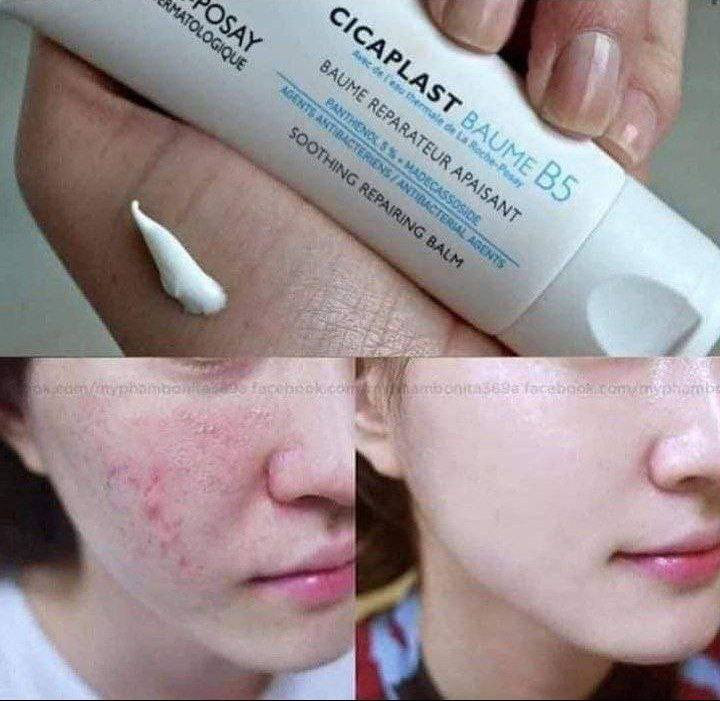 ‏💙+CICAPLAST_BAUME_B5 
من شركة لاروش بوزية 
وفرنا لكم كريم سيكا بلاست الاصلي متعدد الاستعمالات 

✅كريم سيكا بلاست من لاروش بوزيه الفرنسيه 🇫🇷 
✅ لإصلاح وتهدئة وحماية البشرة من (التهيج ،التشقق ، 
البقع الخشنة ). 
✅لترميم البشرة وحمايتها من الجفاف ما بعد الليزر 
وبعد التقشير. بعد الديرما بن او ديرما رولر 
✅يستخدم لتهدئة تهيجات البشرة بعد جلسات (الديرمابن والديرما رولر و بعد الهيدرافيشيال) . 
✅ تقدري تستخدميها ك ترطيب للبشره الجافه اللي ماينفعش معاها الترطيب العادي. 
✅يمكن تطبيقها على الجسم والوجه 😘 
✅مناسبة جداً للبشرة الحساسة 
✅ مفيد جدا لجلد الوزة ولازالة كافة انواع الندب ع الجلد واثار الجروح 
والحروق وحفر الوجه واثار حب الشباب المستعصية 
واثار العمليات الجراحية  والتشققات الجلدية 
يرمم البشرة بشكل سريع  خلال فترة بسيطة 🤗
المنشأ فرنسي 🇫🇷 
🚘 يوجد خدمة توصيل لجميع محافظات العراق 🚘


**إذا كنت صاحب هذا الإعلان وتريد حذفه لأي سبب، رجاءا أرسل رسالة إلى الدعم الفني**