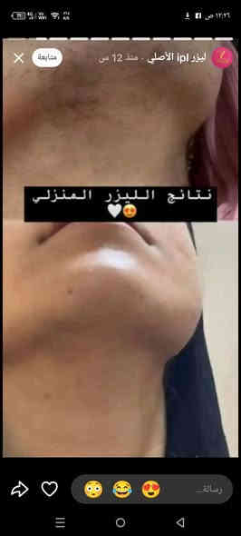 مرحبا بنات توفر اليزر المنزلي الاصلي ipl ابو 5مليون ضربة للحجز والاستفسار الاتصال على الرقم ***********
