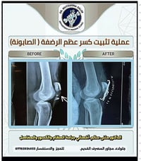 تثبيت الرضفة • د مثنى سالم • جلولاء