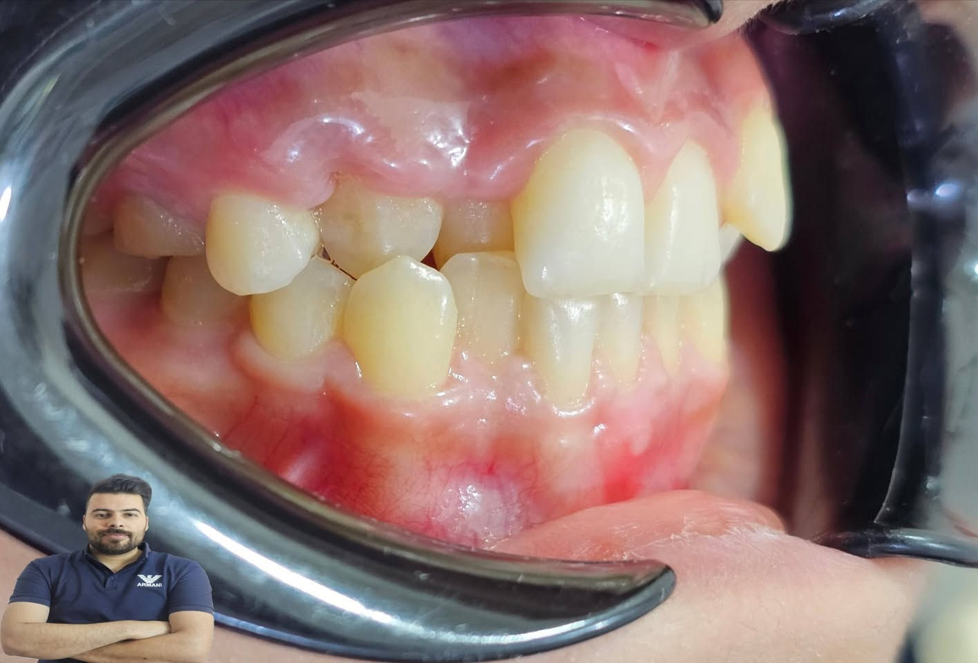 فاطمة اجتنة عدها اسنان لبنية وعدهة سن مطمور ضاحك وعدها الناب الدائمي صاير بالمقدمة وسنين اماميات راجعات ليورة خلال سنة وثلاث اشهر كدرنة نحل اغلب هاي المشاكل 

العنوان / المسيب / شارع البلدية / مقابل دكتور جعفر وفي للاطفال مجاور عالم الحليب

للحجز والاستفسار 
***********
***********
