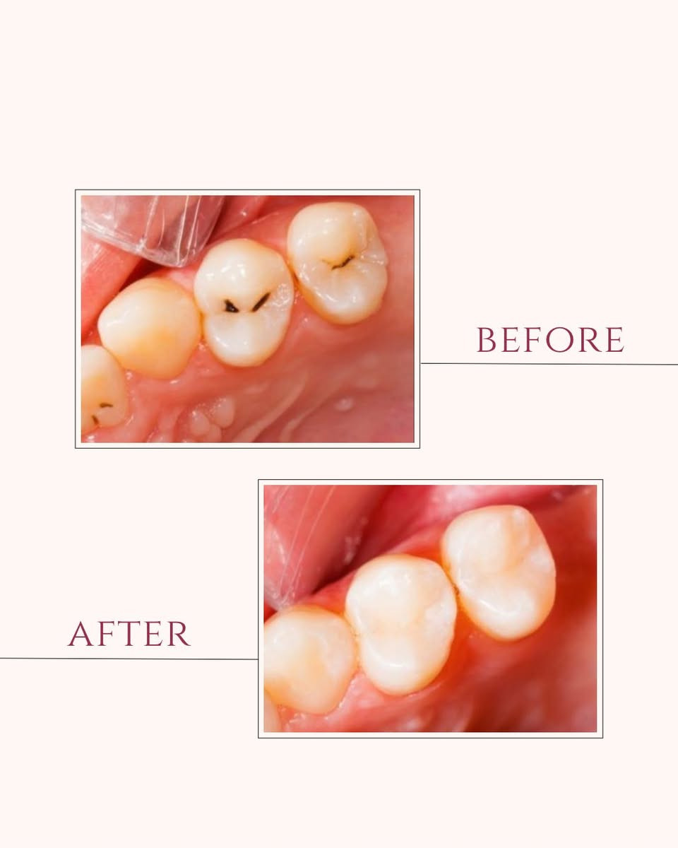 🌙✨ عروض آخر أسبوع من رمضان – مجمع السيف الطبي لطب الأسنان ✨🌙

قبل العيد… اعتنِ بابتسامتك واستفد من عروضنا الخاصة:

🦷 خصومات على حشوات الأسنان  
🦷 خصومات على حشوات الجذور (سحب العصب)  
🦷 خصومات على قلع الأسنان

🎁 عرض خاص: تنظيف أسنان مجاناً مع كل حشوة  
🔎 معاينة مجانية طوال هذا الأسبوع

👨‍⚕️ بإشراف: الدكتور علي سالم جمعة

📍 الموقع: بغداد – الكميرة قرب جامع أبو الزهراء  
🗓 أيام الدوام: السبت – الاثنين – الأربعاء  
📞 للتواصل والاستفسار والحجز: ***********

✨ ابتسامتك تهمنا…
نموذج عن الشغل
