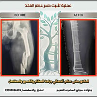 تثبيت كسر • عظم الفخذ • د مثنى سالم