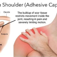 التهاب محفظة الكتف، المعروف أيضًا باسم الكتف المتجمدة Shoulder capsuli...