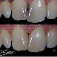 الي عنده تسوسات بين الاسنان الاماميه ويريد يعالجهم يتصل ع هذا الرقم 07...