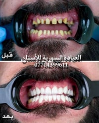 مختبر أسنان • تعويضات سنية • زيارات منزلية