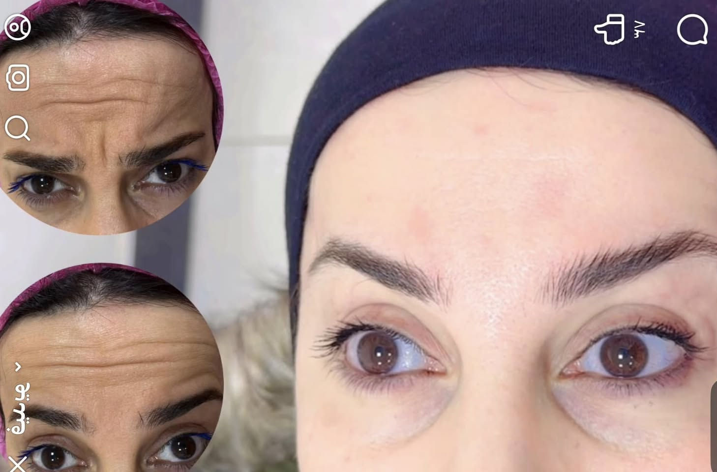 هذا ابدااع الدكتورة حنين الصراف في التجميل في الفلر والبوتوكس والخطوط الضاحكة … شكرا لطبيبة التجميل العراقية بنت 
الكوت


**إذا كنت صاحب هذا الإعلان وتريد حذفه لأي سبب، رجاءا أرسل رسالة إلى الدعم الفني**