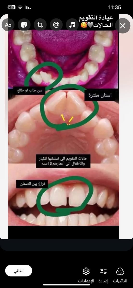 مفتوحه
يوم السبت :عيادة الاطفال. عيادة التقويم. 
يوم الاثنين : عيادة الحشوات وعيادة التنظيف 

يوم الثلاثاء : عيادة علاج حالات الفم 
وعيادة التنظيف 
وعيادة القلع 

للحجز يرجى مراسلة الصفحه 
او الاتصال ع رقم 
***********
علماا ان العلاج مجاني فقط سعر الباص 

العنوان: شارع اربعين مجاور صيدلية سلامتك ✨
