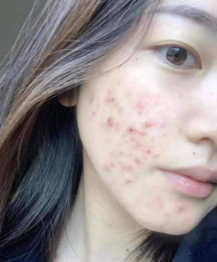 عندج حبوب بالوجه ومأذية بشرتج؟ استخدمي غسول وكريم من لاروش بوزيه!" 🛑
يعالج الحبوب من الجذور ويمنع ظهورها مرة ثانية. متوفر عدد قليل جداً، لا تفوتين الفرصة


**إذا كنت صاحب هذا الإعلان وتريد حذفه لأي سبب، رجاءا أرسل رسالة إلى الدعم الفني**