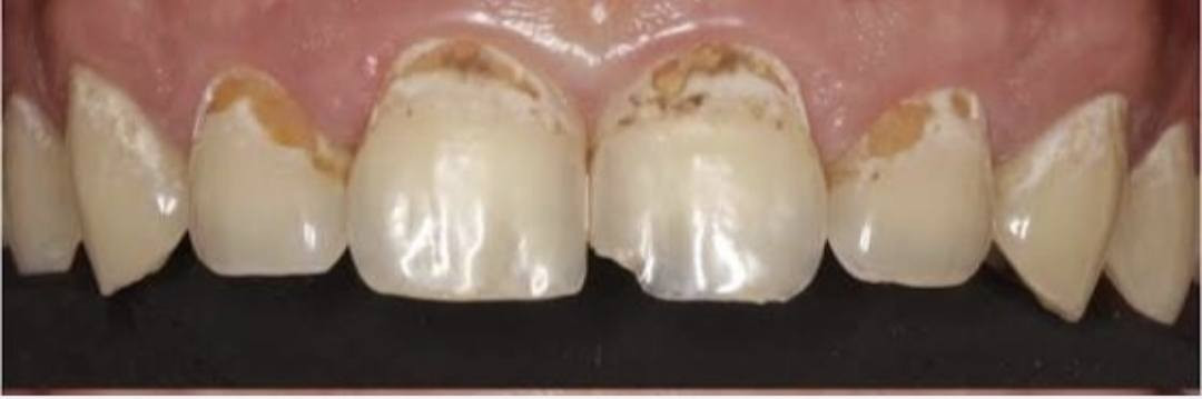 مجاناااااا
الي عنده هيج تسوس باسنانه مثل الي بالصورة ويريد يعالجه بحشوة ضوئية يتواصل ويايه خاص اويتصل على الرقم *********** والعلاج مجاناً
العنوان حلة شارع 40 مجاور صيدلية سلامتك
