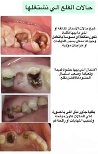 قلع اسنان • علاج مجاني • جامعة القادسية
