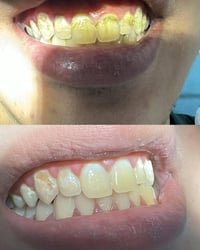 تنظيف أسنان • حشوات مجانية • قلع جذور مجاني