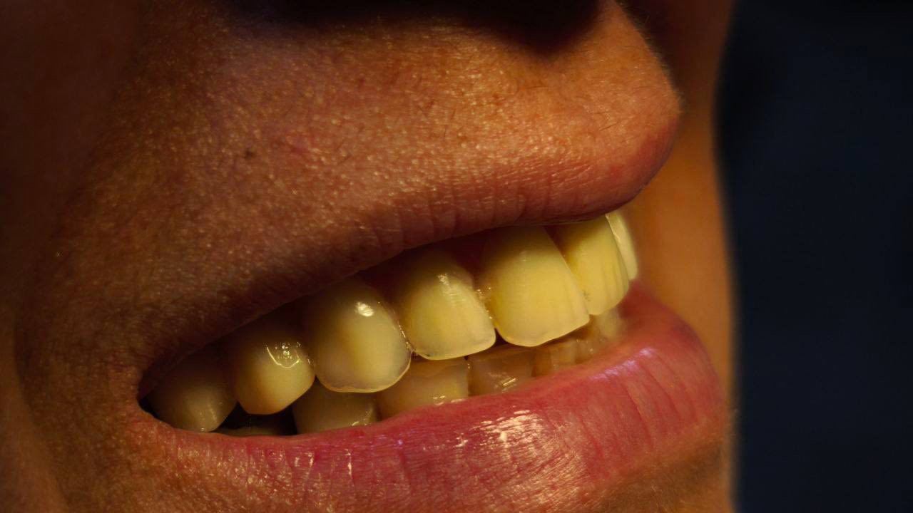 السلام عليكم منو يريد طقم أسنان مجاني بس كون جاهز للطبعة وأهم شي ملتزم العلاج مجاني
***********
